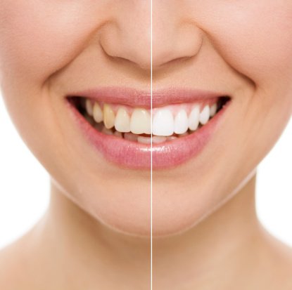 ¿El blanqueamiento dental debilita las piezas?